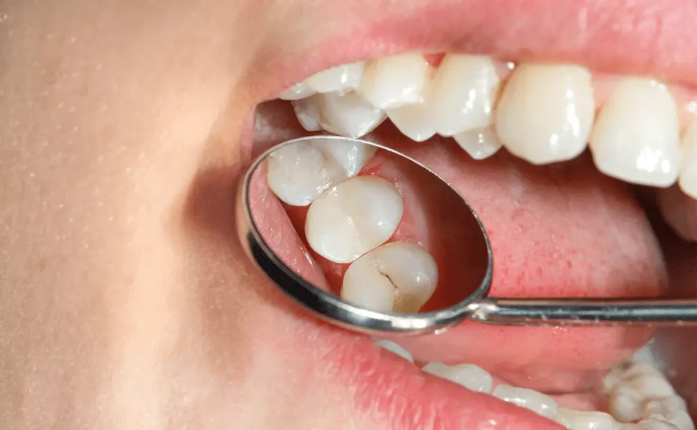 Enfermedad de los dientes: Cómo la inteligencia artificial está revolucionando el cuidado dental - Cuáles son las enfermedades de los dientes enfermedad de los dientes inteligencia artificial - Cuáles son las enfermedades de los dientes