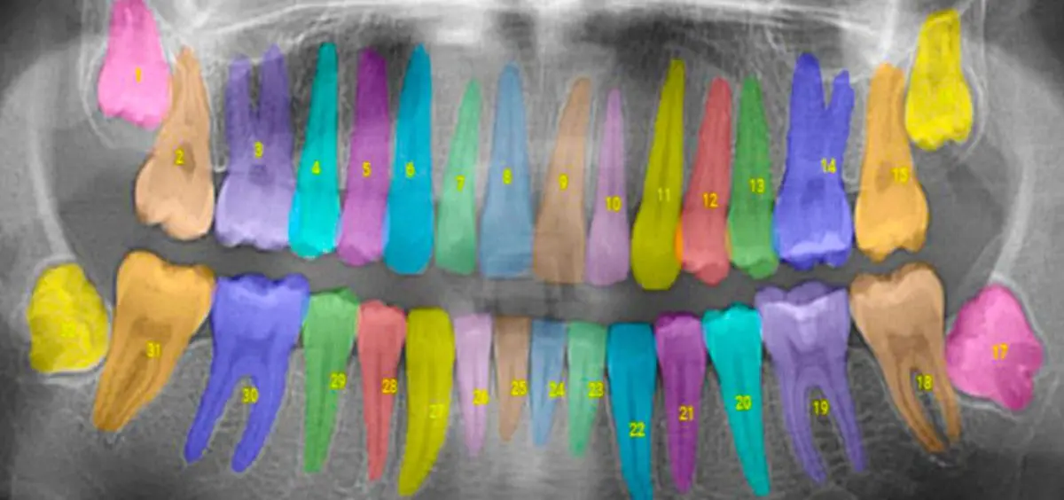 Enfermedad de los dientes: Cómo la inteligencia artificial está revolucionando el cuidado dental - Por qué se produce la piorrea enfermedad de los dientes inteligencia artificial - Por qué se produce la piorrea