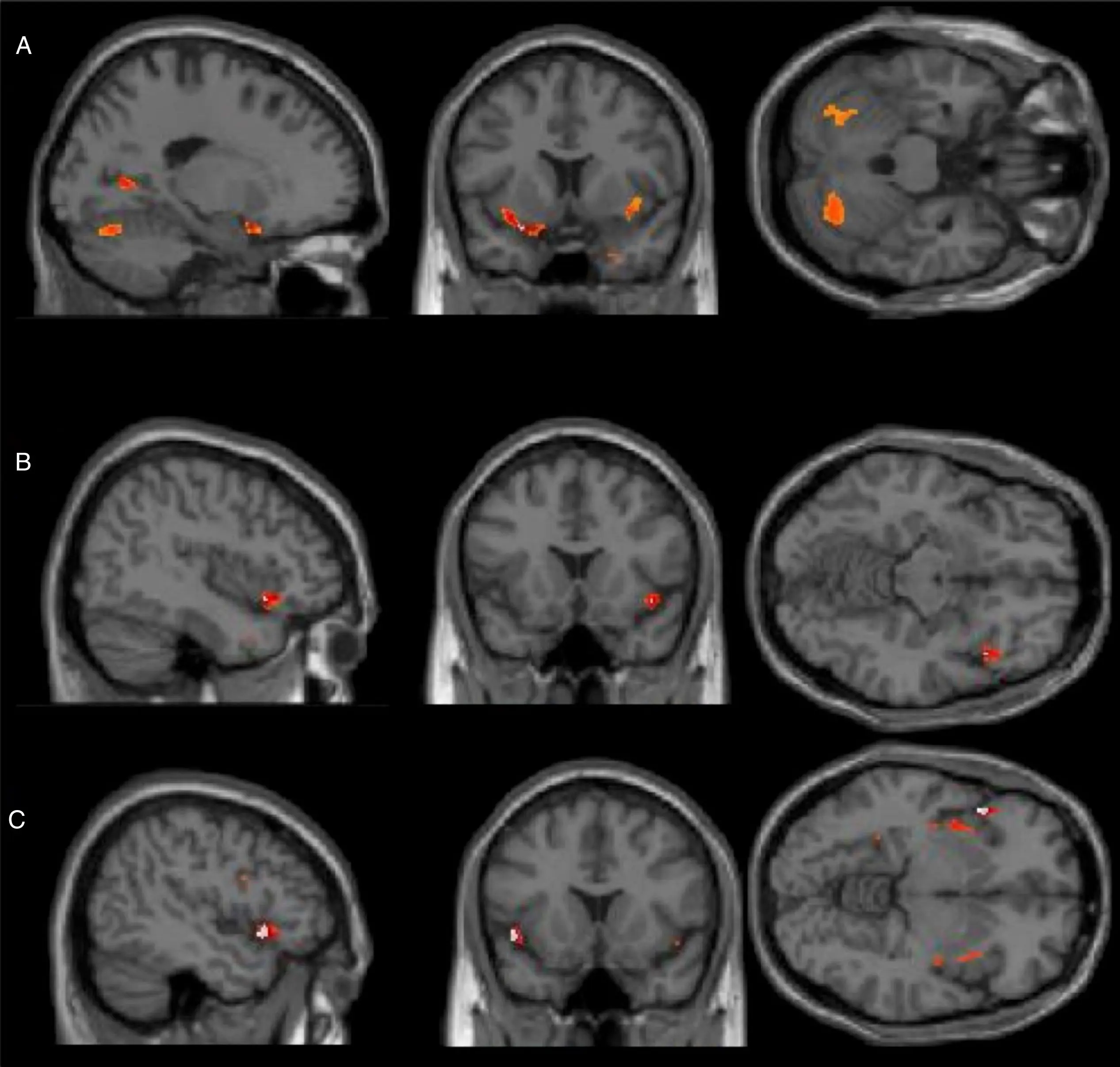 cerebros inteligentes en una resonancia magnetica funcional - Que detecta la resonancia magnética funcional