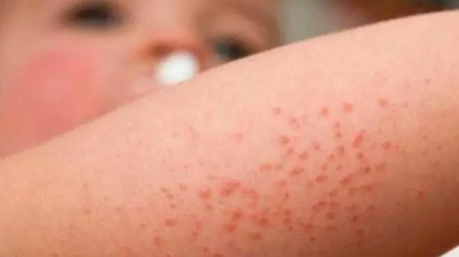 Dermatitis Atópica: La inteligencia detrás de esta enfermedad - Que detona la dermatitis atópica dermatitis atopica inteligencia - Que detona la dermatitis atópica