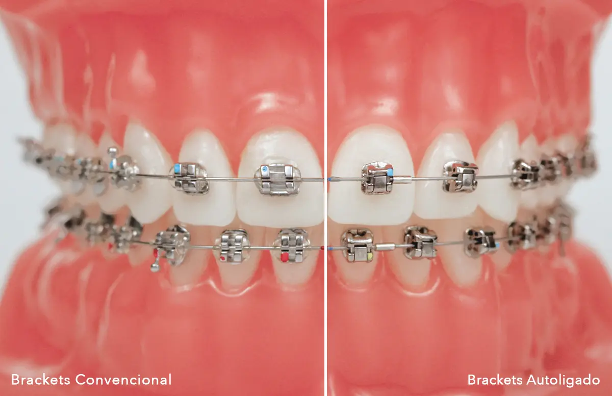 ¿Cuáles son los brackets inteligentes? - Qué es mejor brackets con ligas o sin ligas cuales son los brackets inteligentes - Qué es mejor brackets con ligas o sin ligas