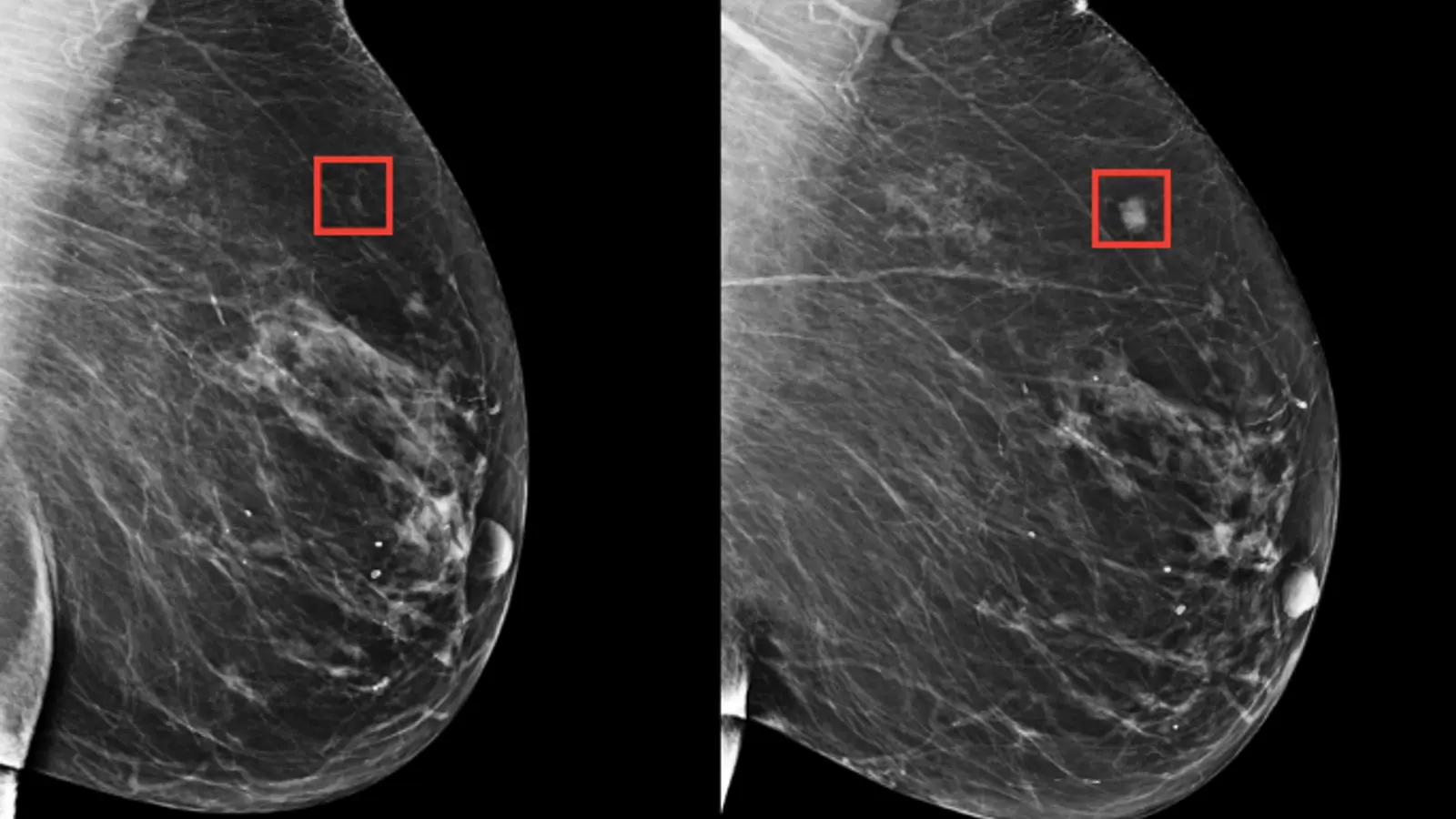 inteligencia artificial en mamografia - Qué tan confiable es una mamografía