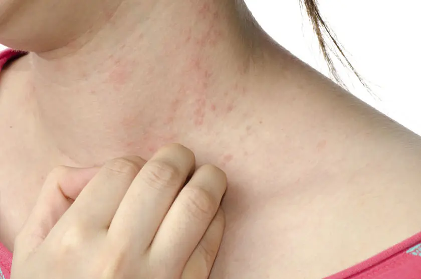 Dermatitis Atópica: La inteligencia detrás de esta enfermedad - Qué tan grave es la dermatitis atópica dermatitis atopica inteligencia - Qué tan grave es la dermatitis atópica